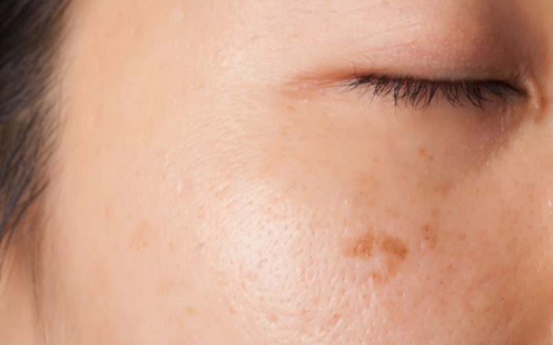 Eliminar manchas de la piel con tratamientos caseros